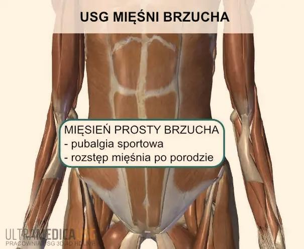 Naderwanie mięśnia brzucha