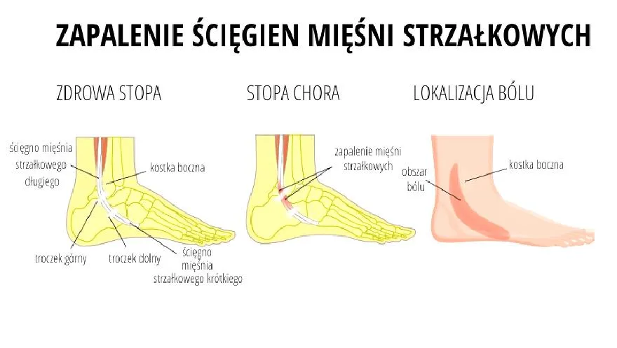 Powikłania zapalenia mięśni